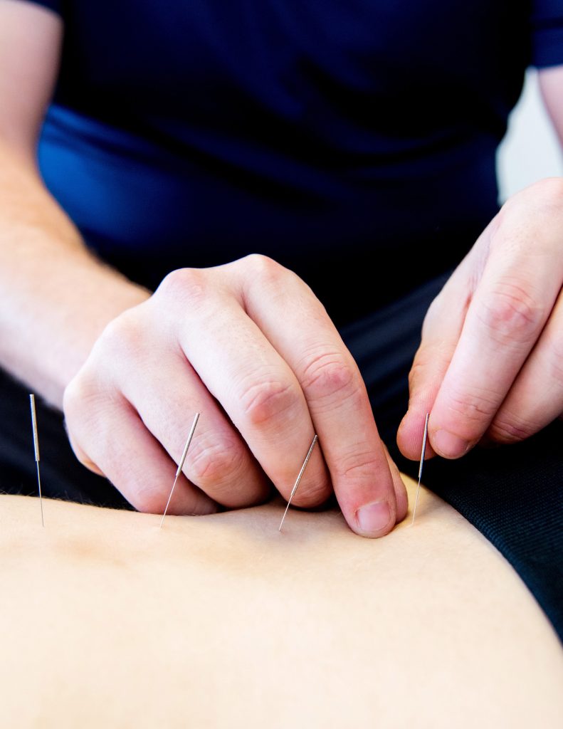 Acupuncture-Brampton
