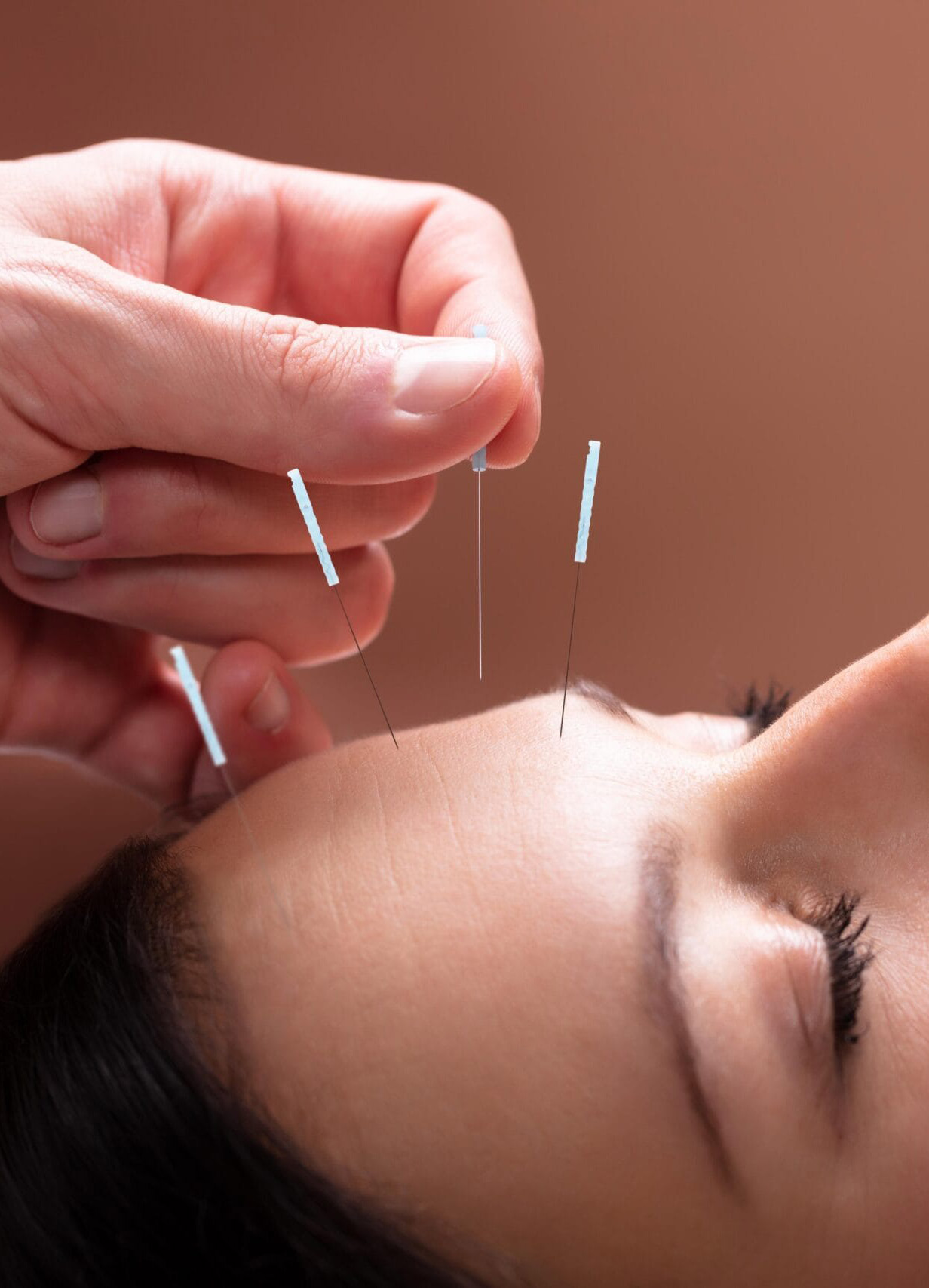 cosmetic-acupuncture