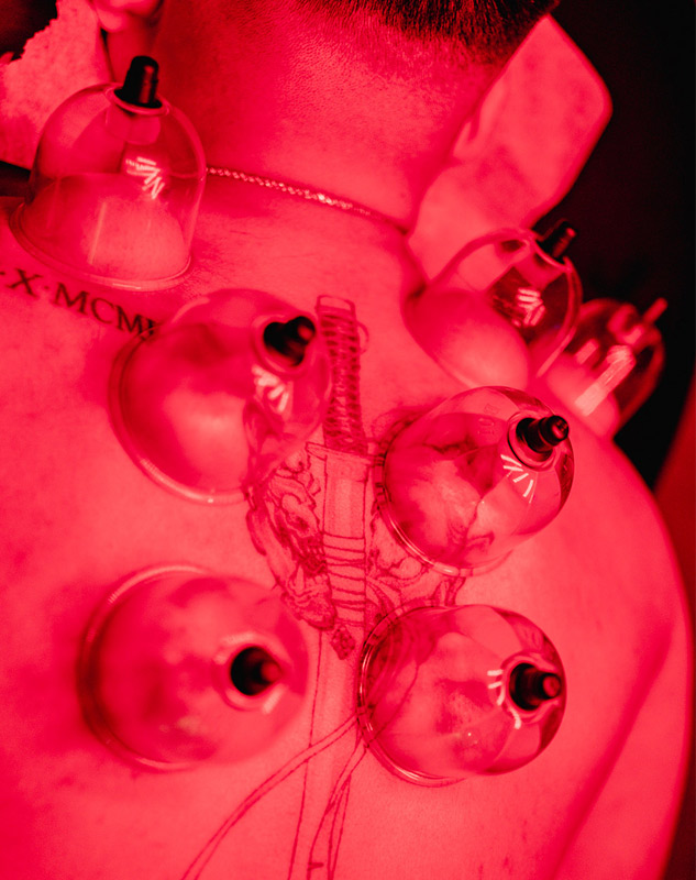 cupping-therapy-brampton