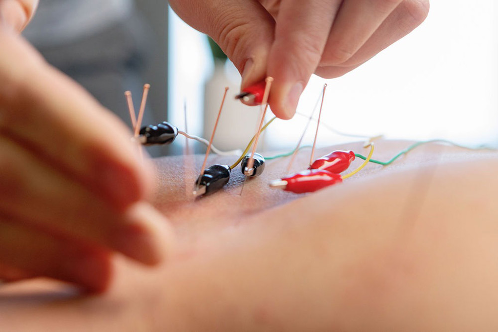 neurofunctional-acupuncture2