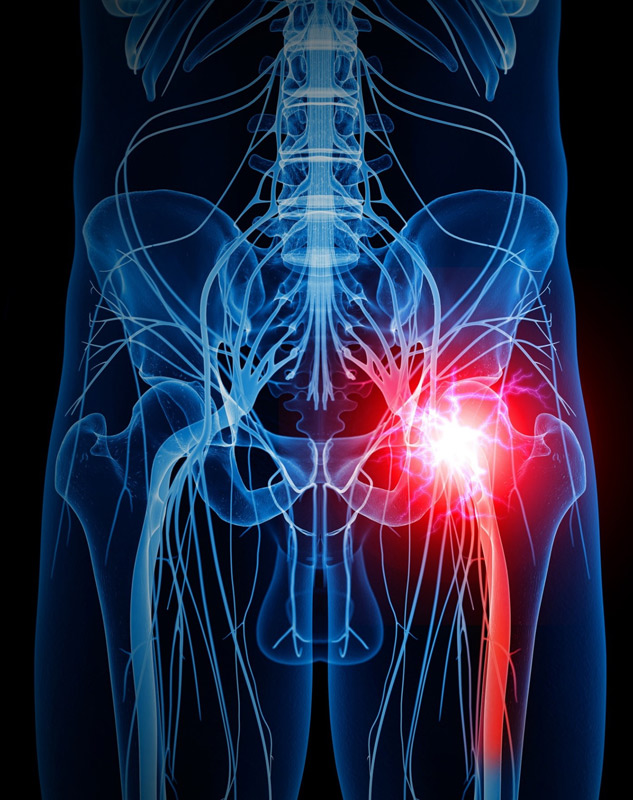 sciatica-pain-treatment